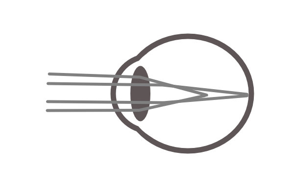 myopia image