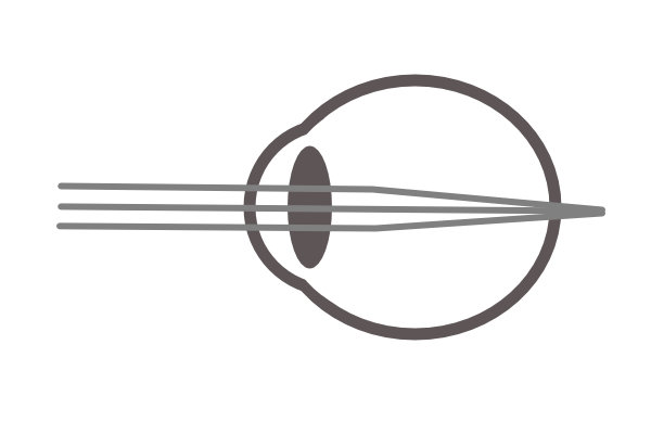 myopia image