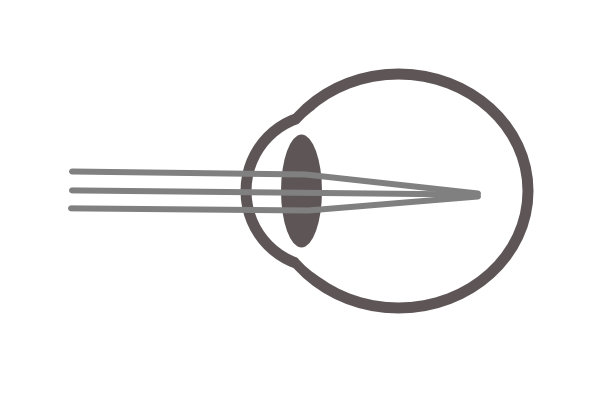 myopia image