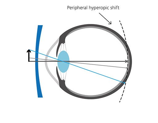 MyoVision Lens Standard